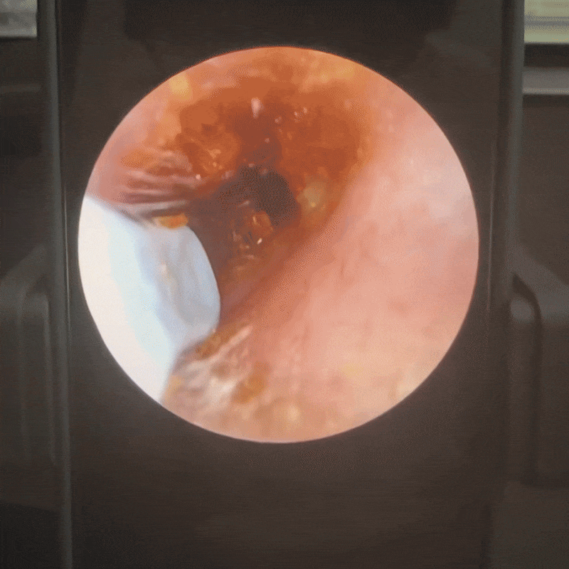 EarClean - Doktor Onaylı 1080P Kulak Temizlik Kamerası